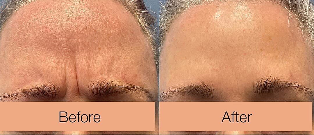 Forehead wrinkles before and after treatment comparison.