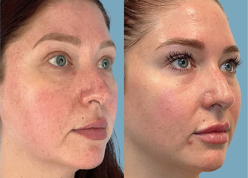 Before and after skin treatment comparison photo.