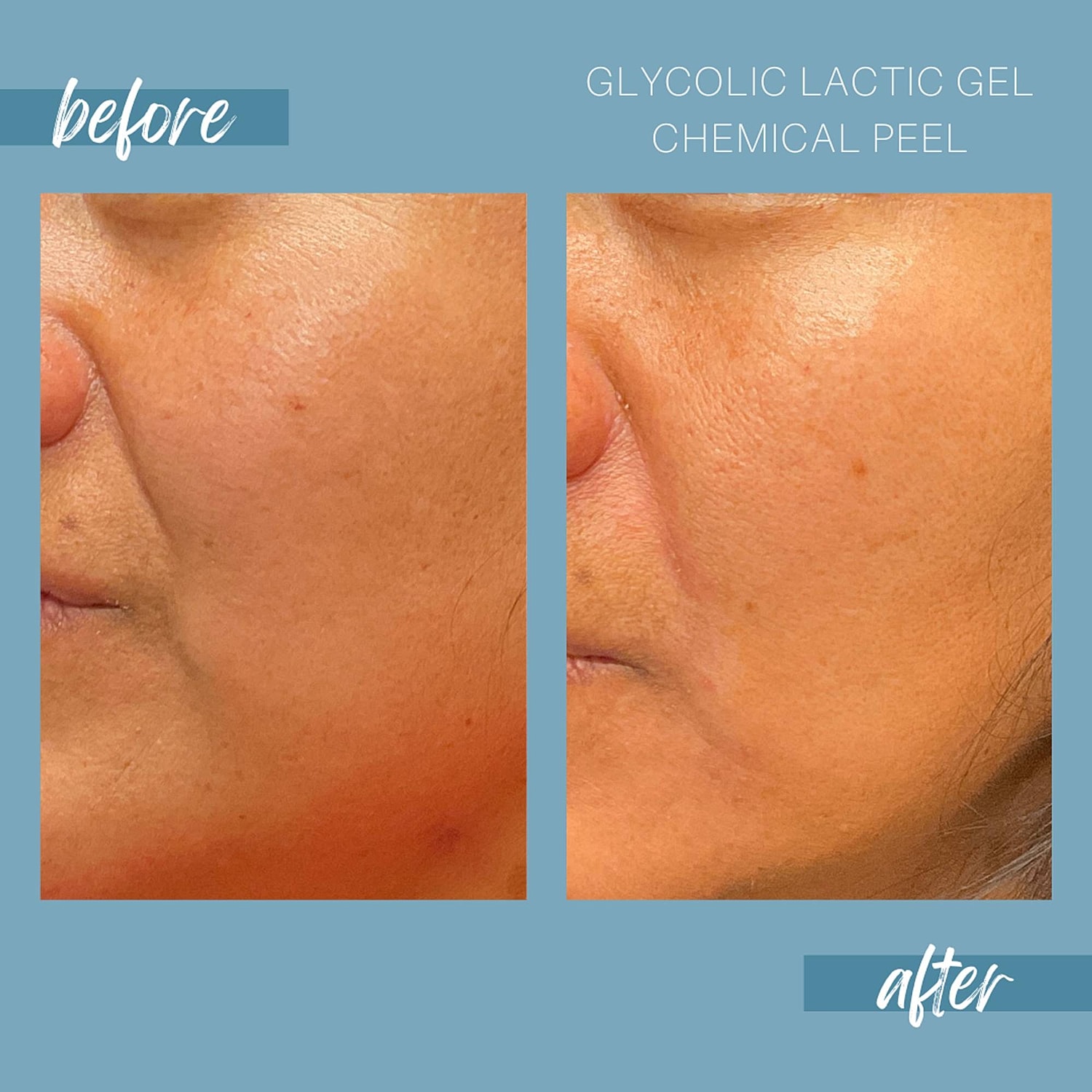 Chemical Peels Before & After