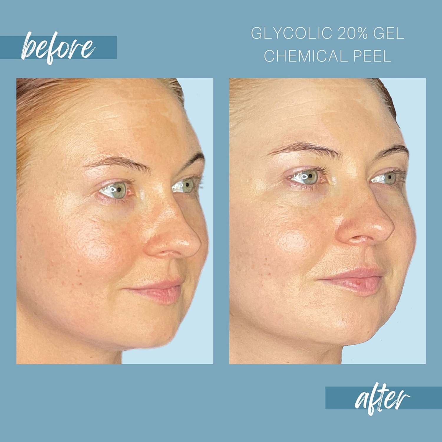 Chemical Peels Before & After