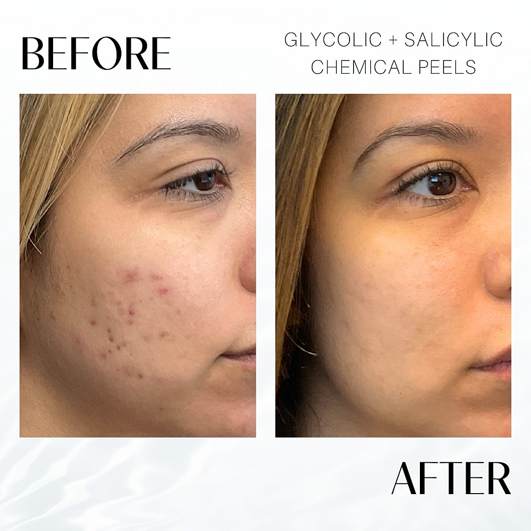 Chemical Peels Before & After