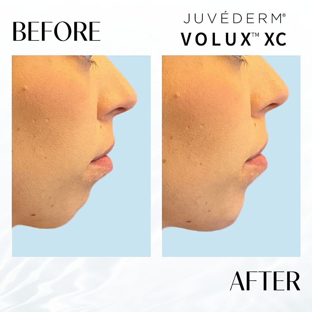 Chin Fillers Before & After