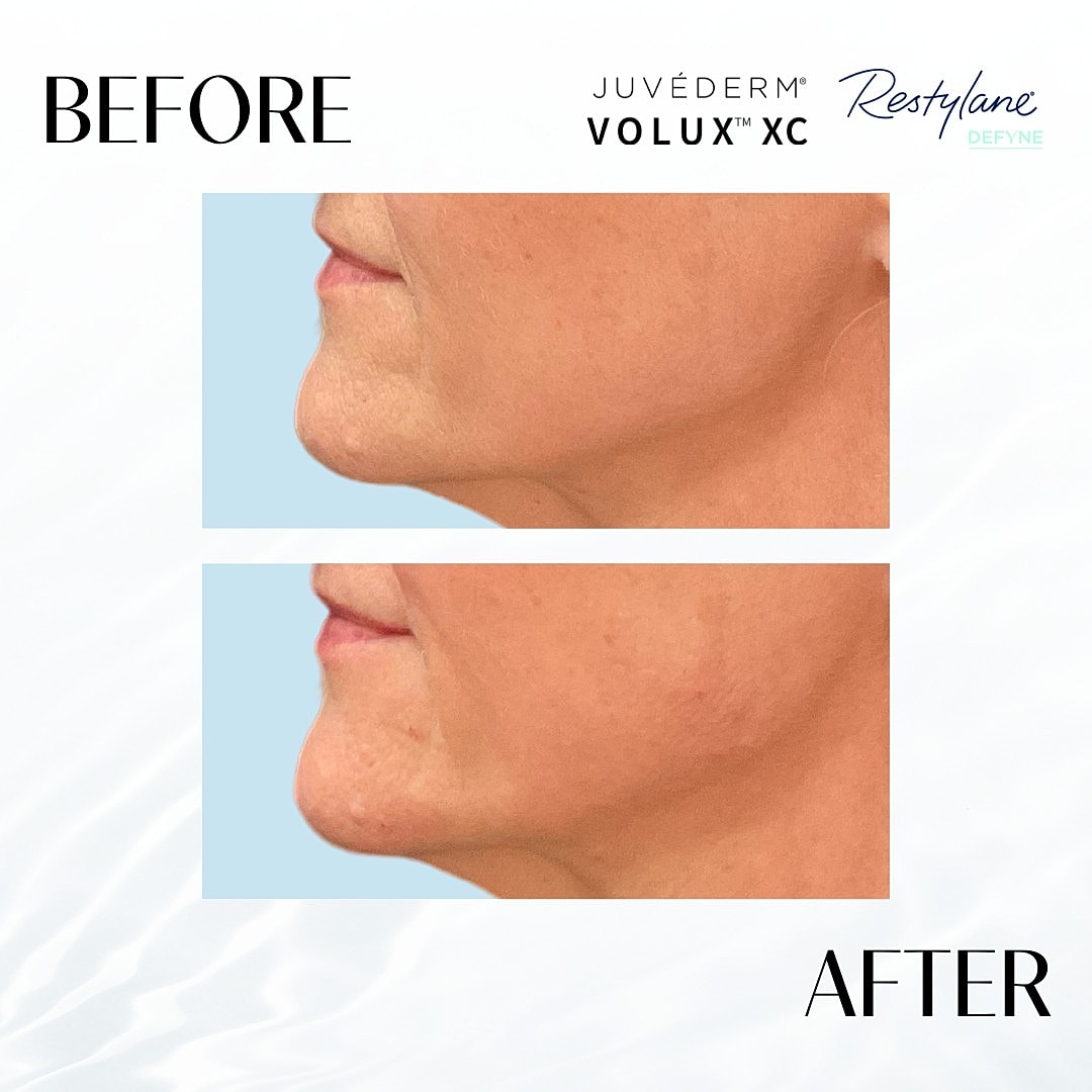 Chin Fillers Before & After