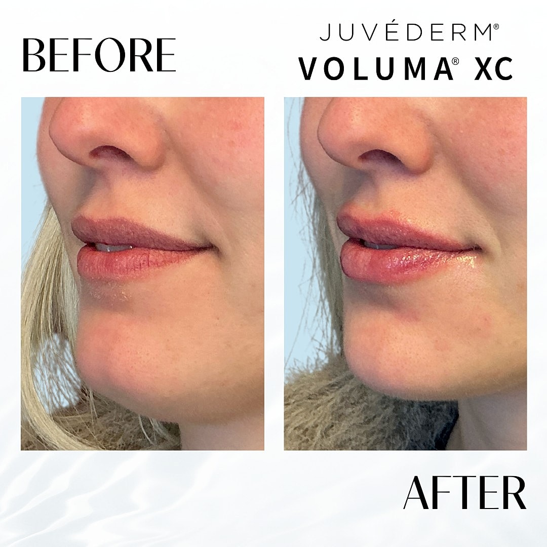 Chin Fillers Before & After