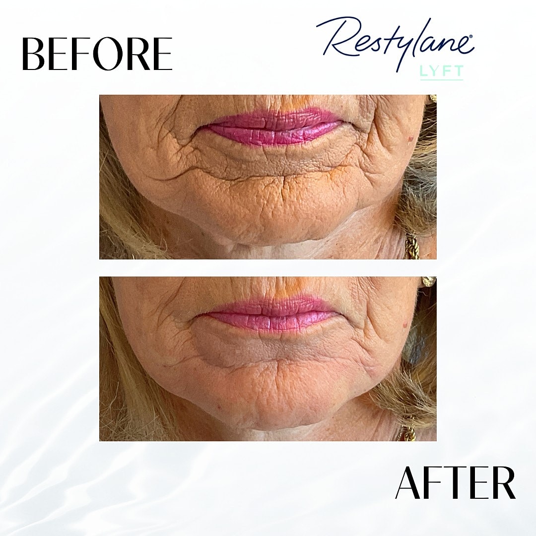 Chin Fillers Before & After