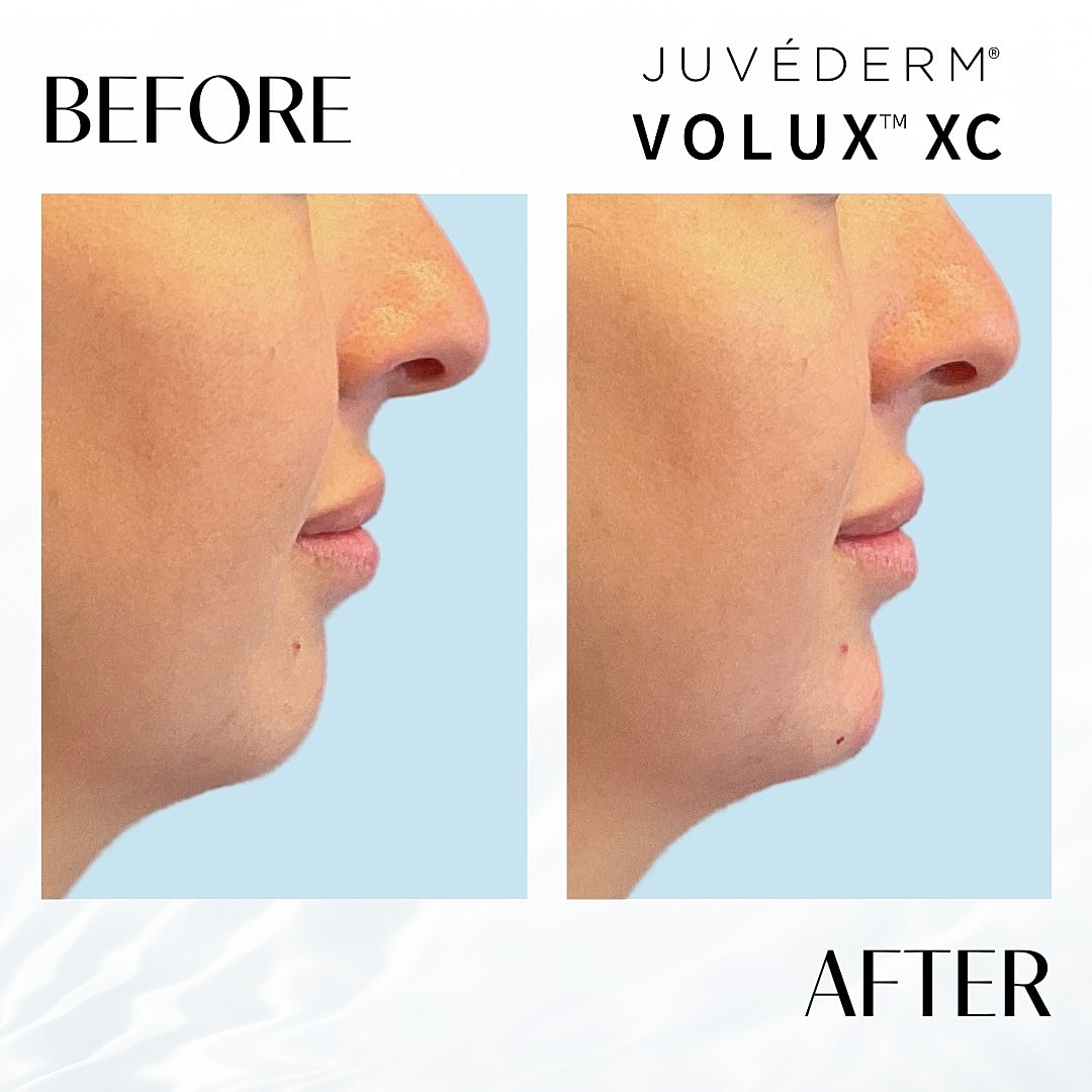 Chin Fillers Before & After
