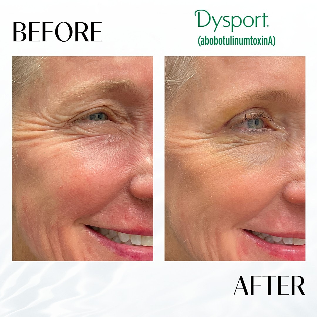 Botox And Dysport Before & After