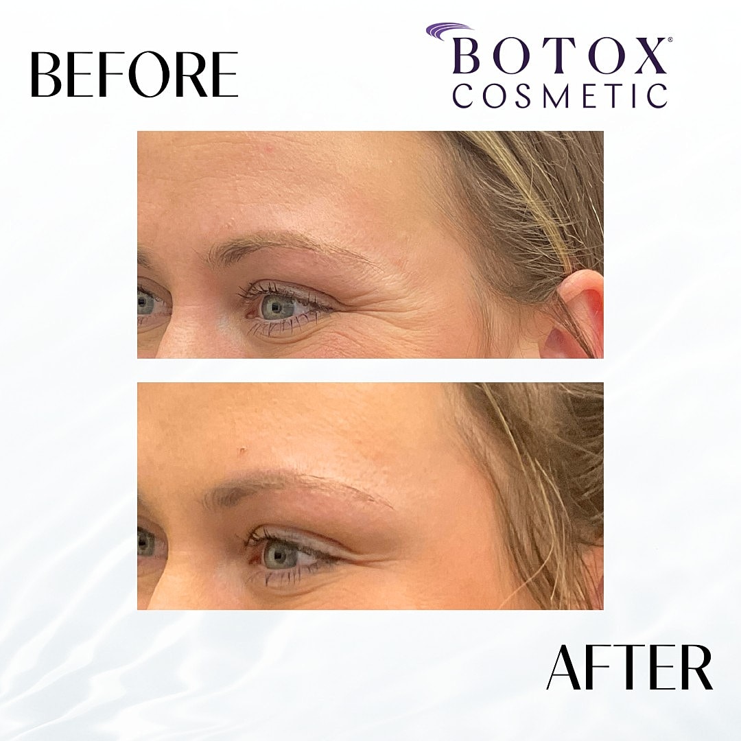 Botox and Dysport Before & Afters | Patient 115797 | Client Name
