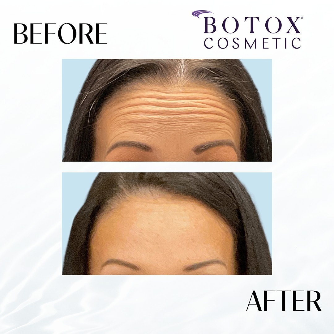 Botox And Dysport Before & After
