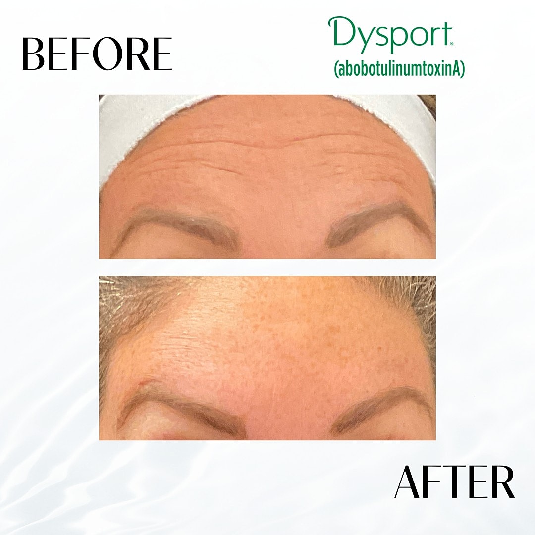Botox And Dysport Before & After