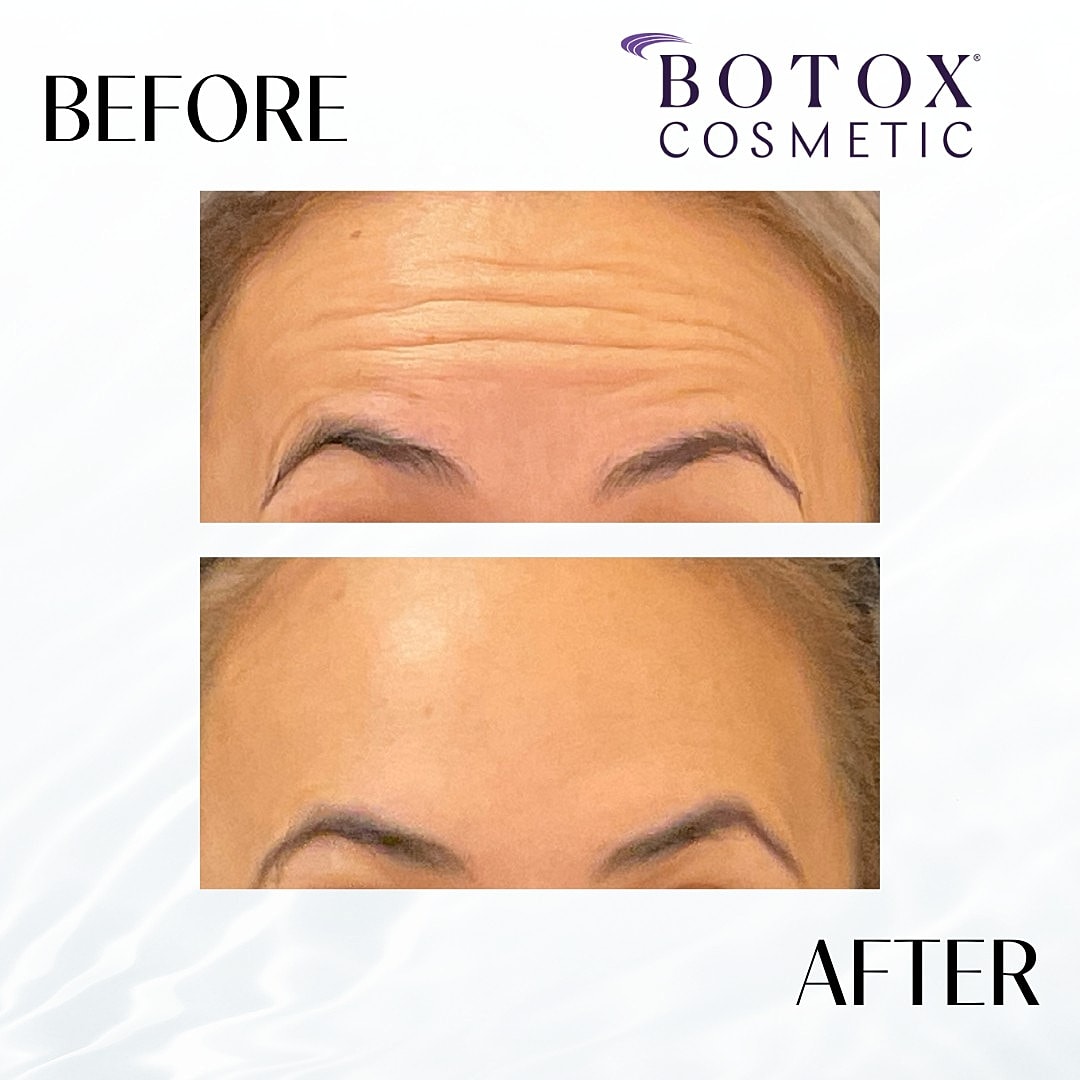 Botox And Dysport Before & After