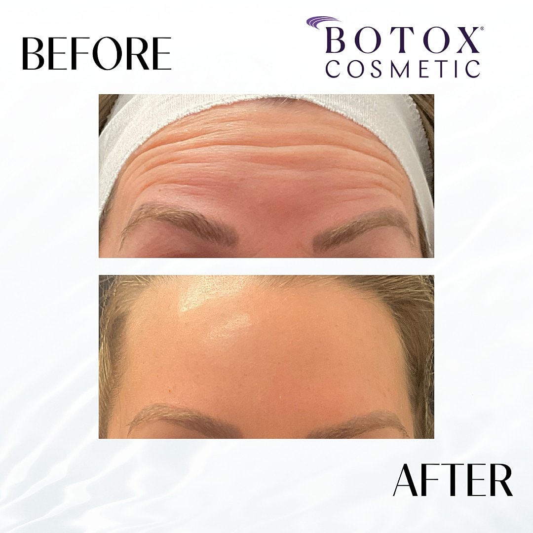 Botox And Dysport Before & After