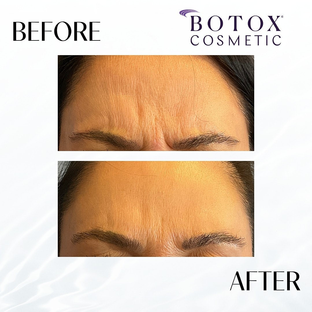 Botox And Dysport Before & After