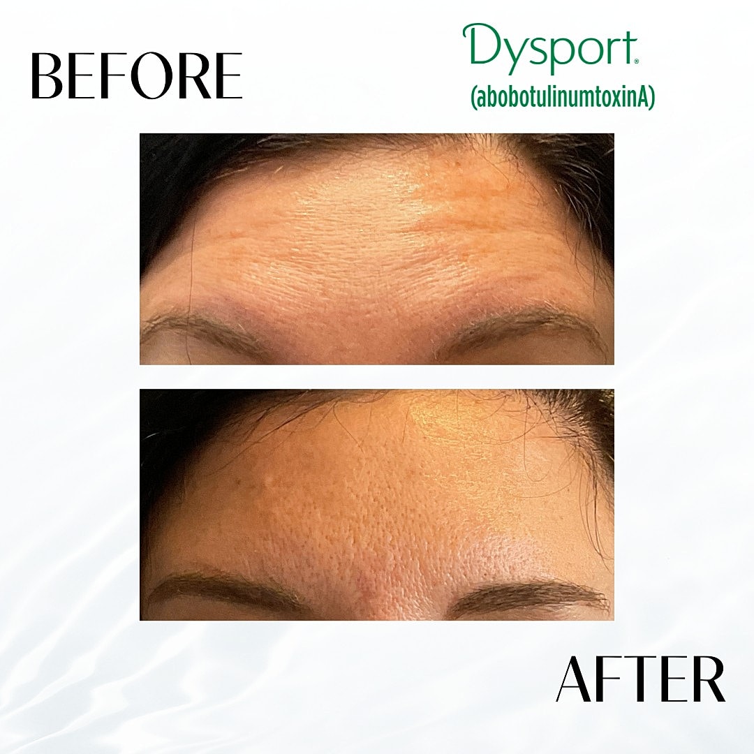 Botox And Dysport Before & After