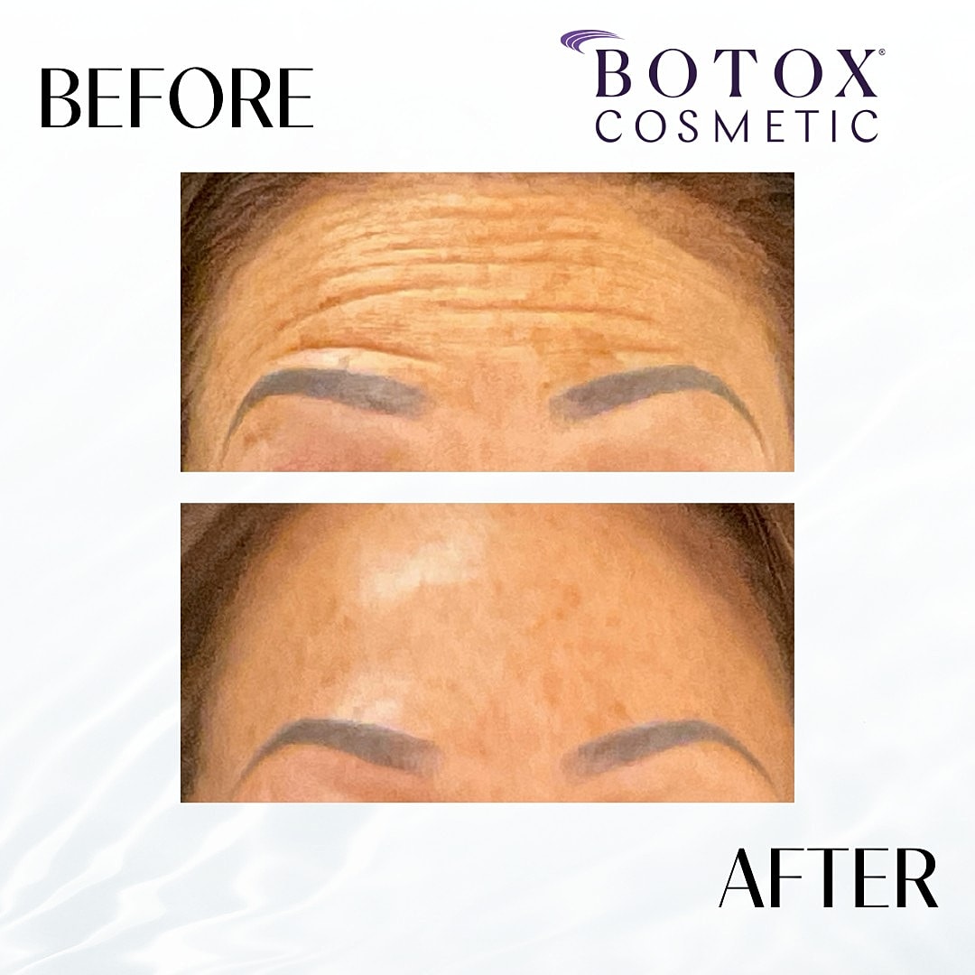 Botox And Dysport Before & After