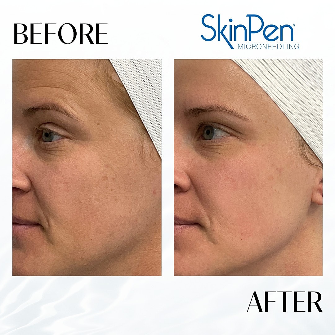 Microneedling Before & After