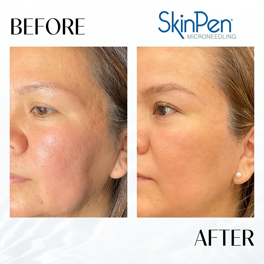 Microneedling Before & After
