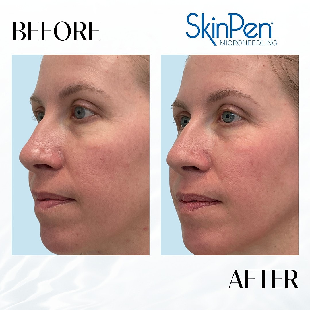 Microneedling Before & After