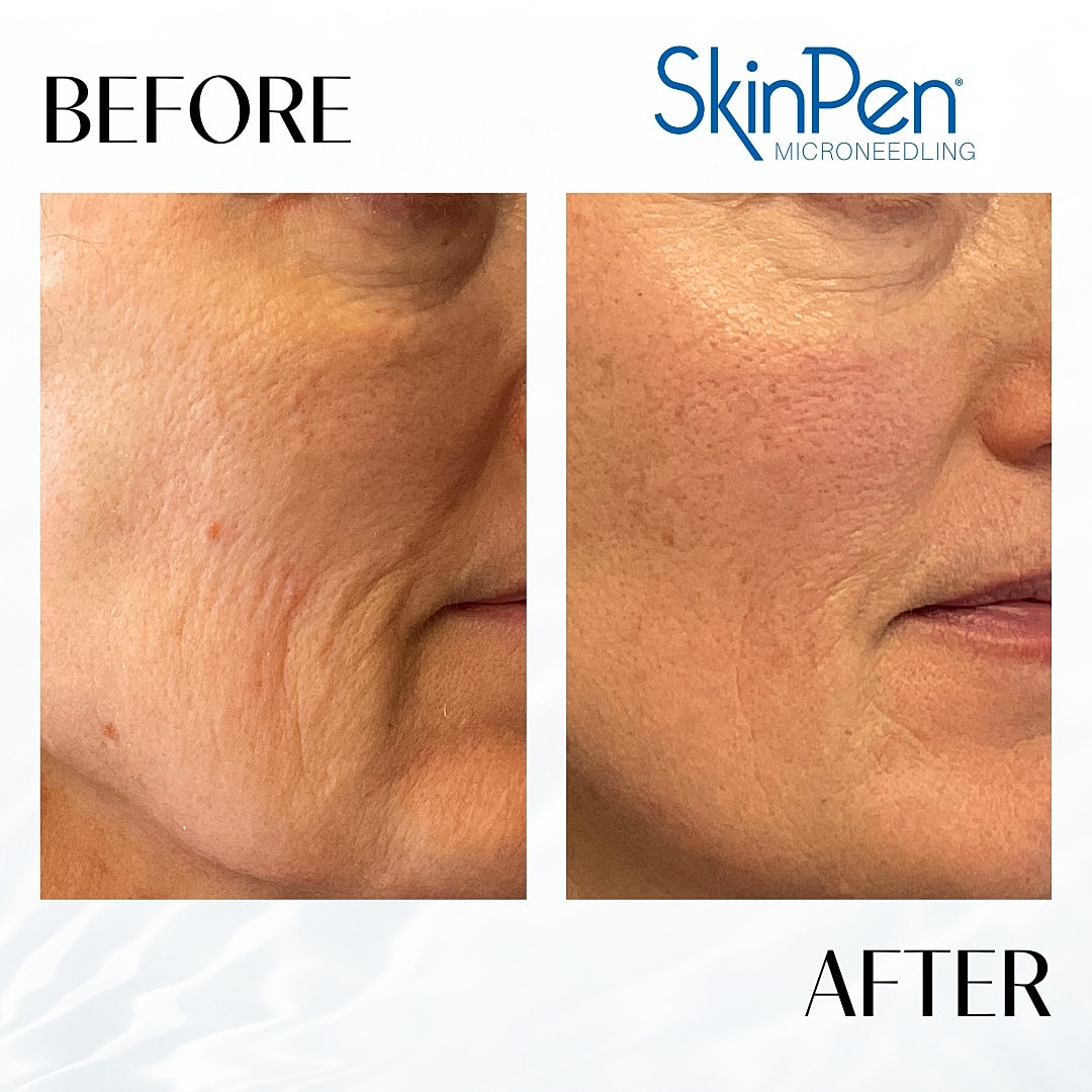 Microneedling Before & After