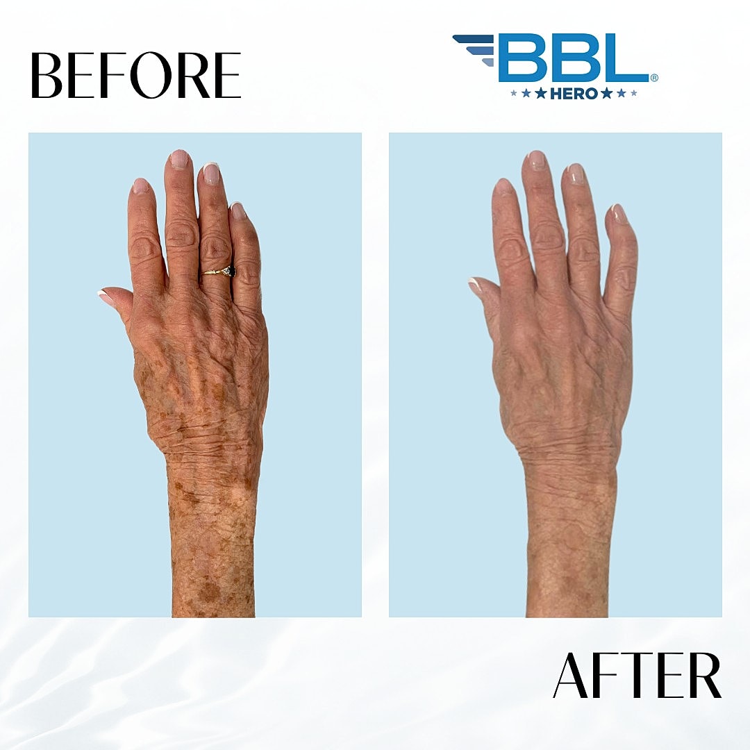 BroadBand Light (Bbl) Before & After