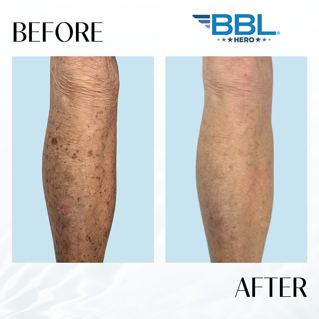 BroadBand Light (Bbl) Before & After