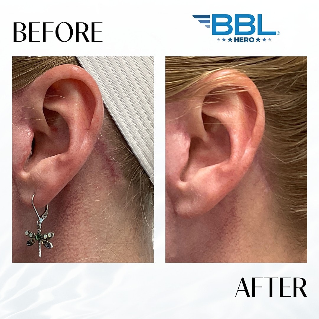 BroadBand Light (BBL) Before & After