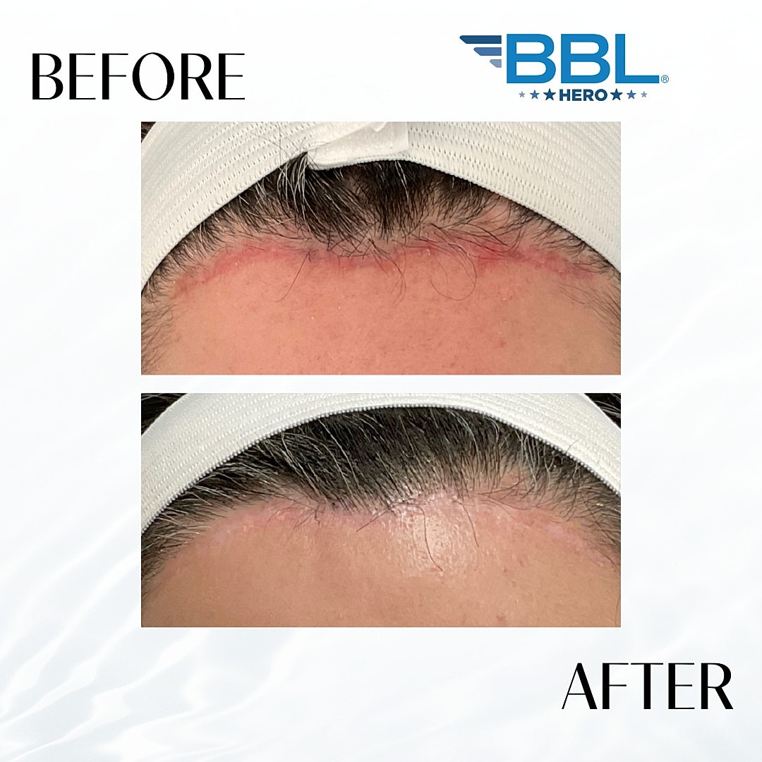 BroadBand Light (BBL) Before & After