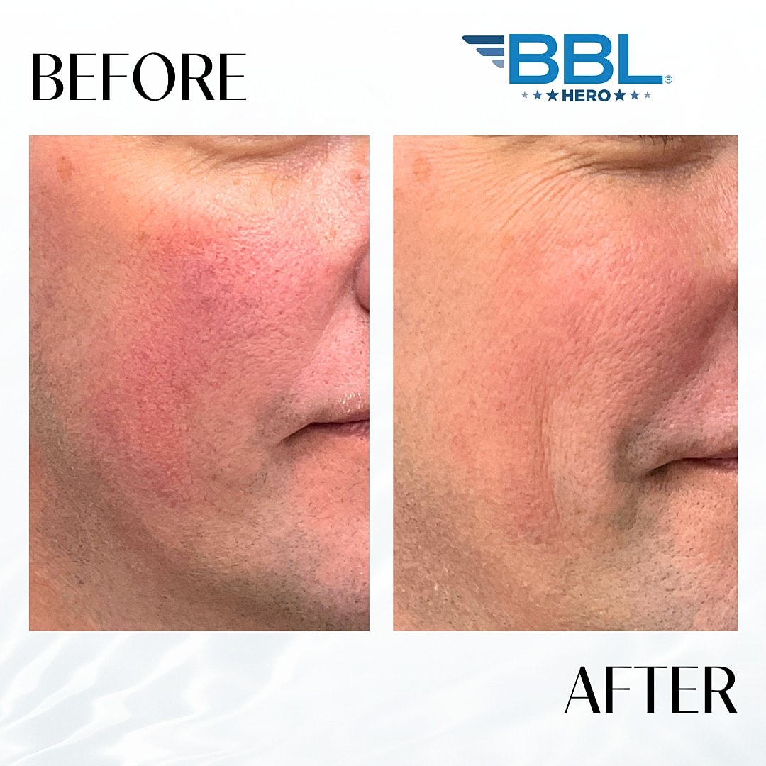 BroadBand Light (BBL) Before & After