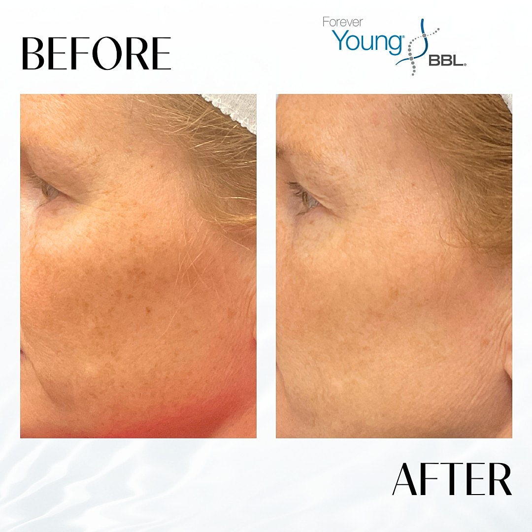 BroadBand Light (BBL) Before & After