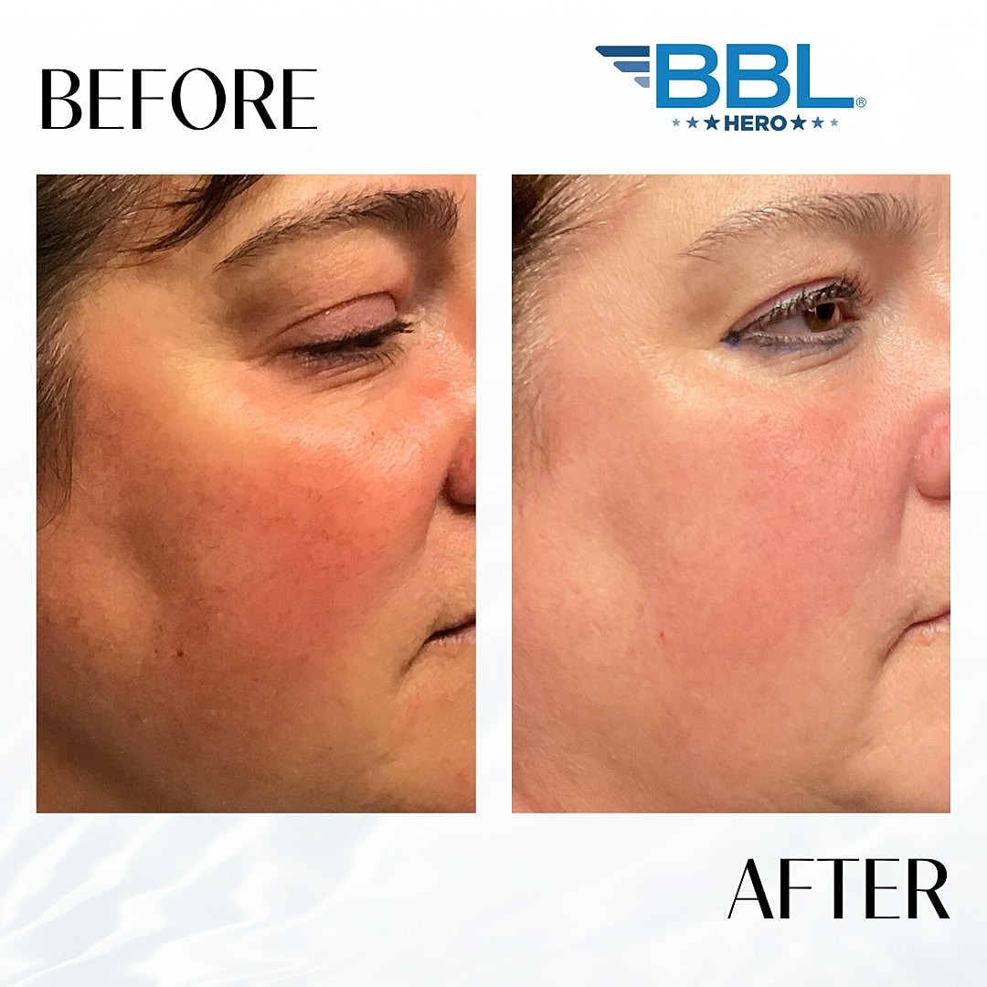 BroadBand Light (Bbl) Before & After
