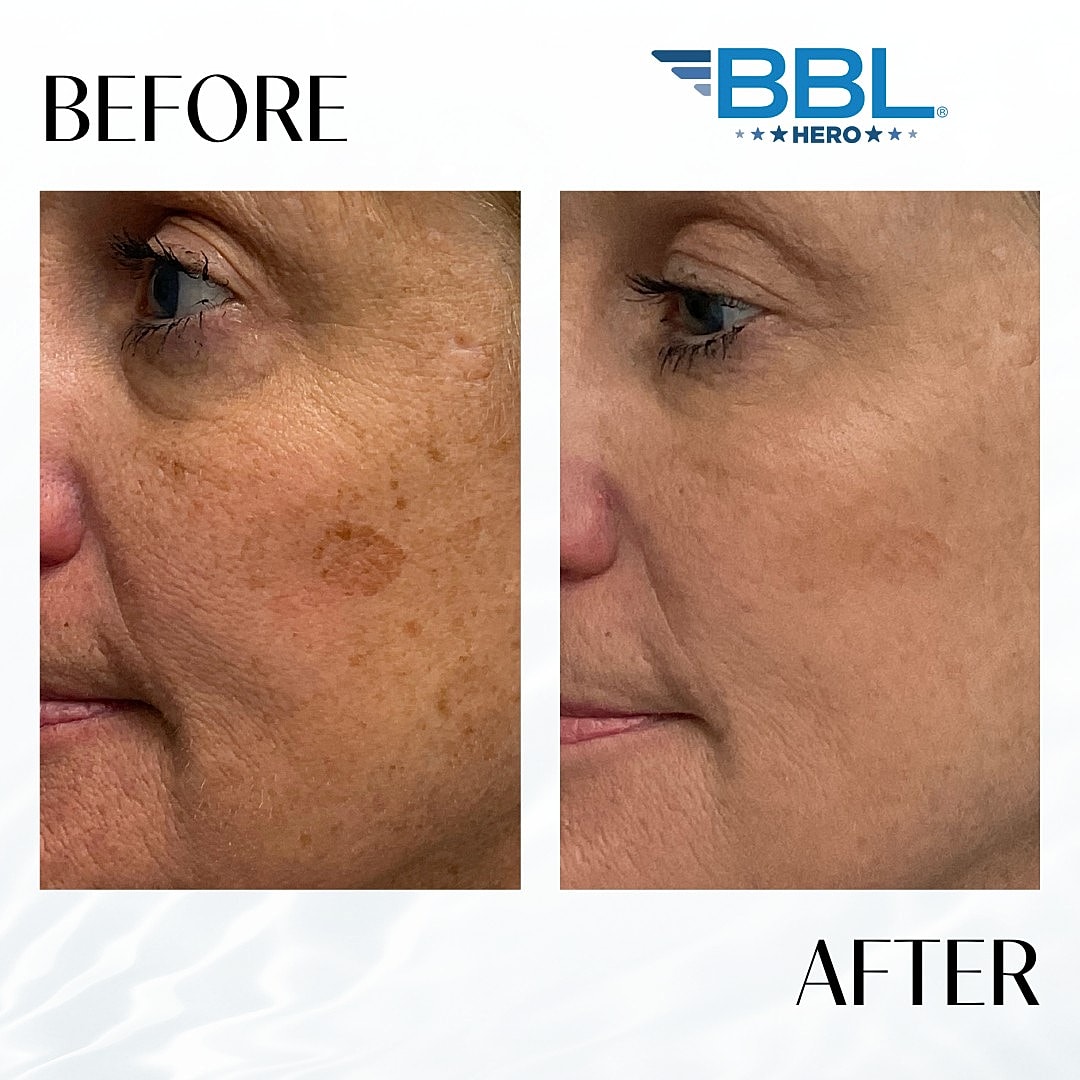 BroadBand Light (Bbl) Before & After