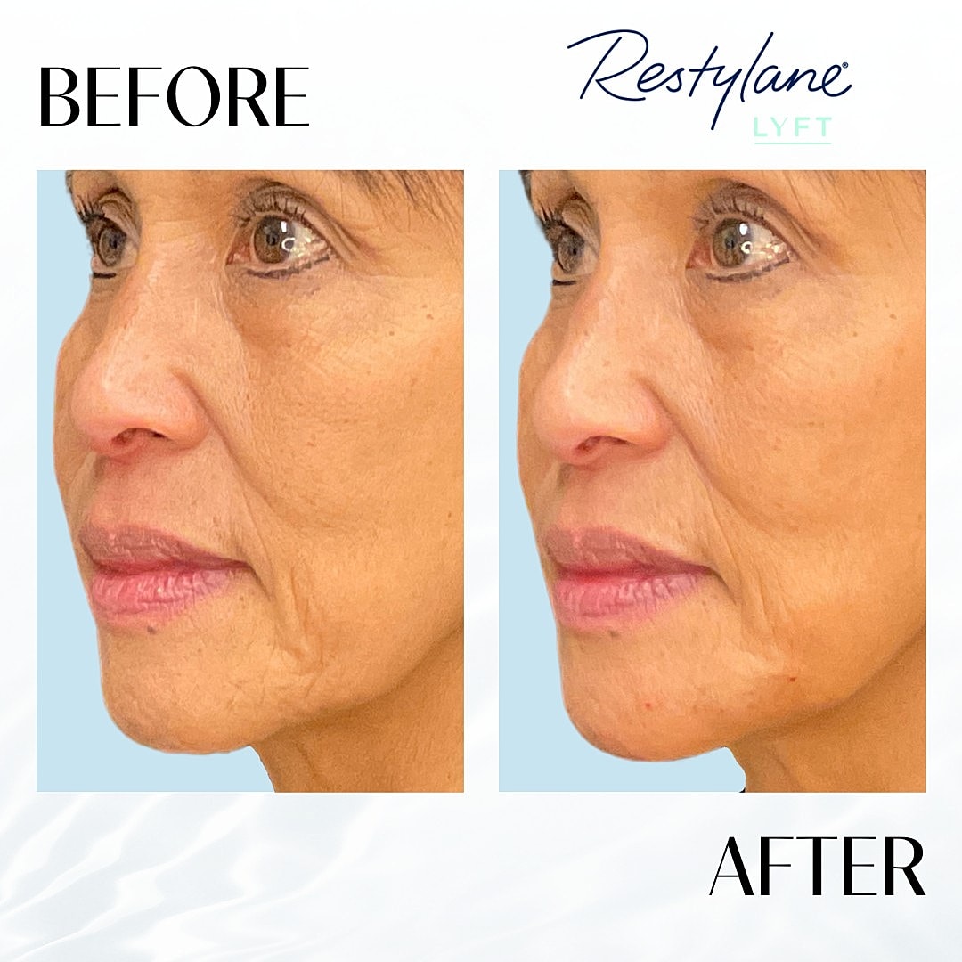 Facial Fillers Before & After