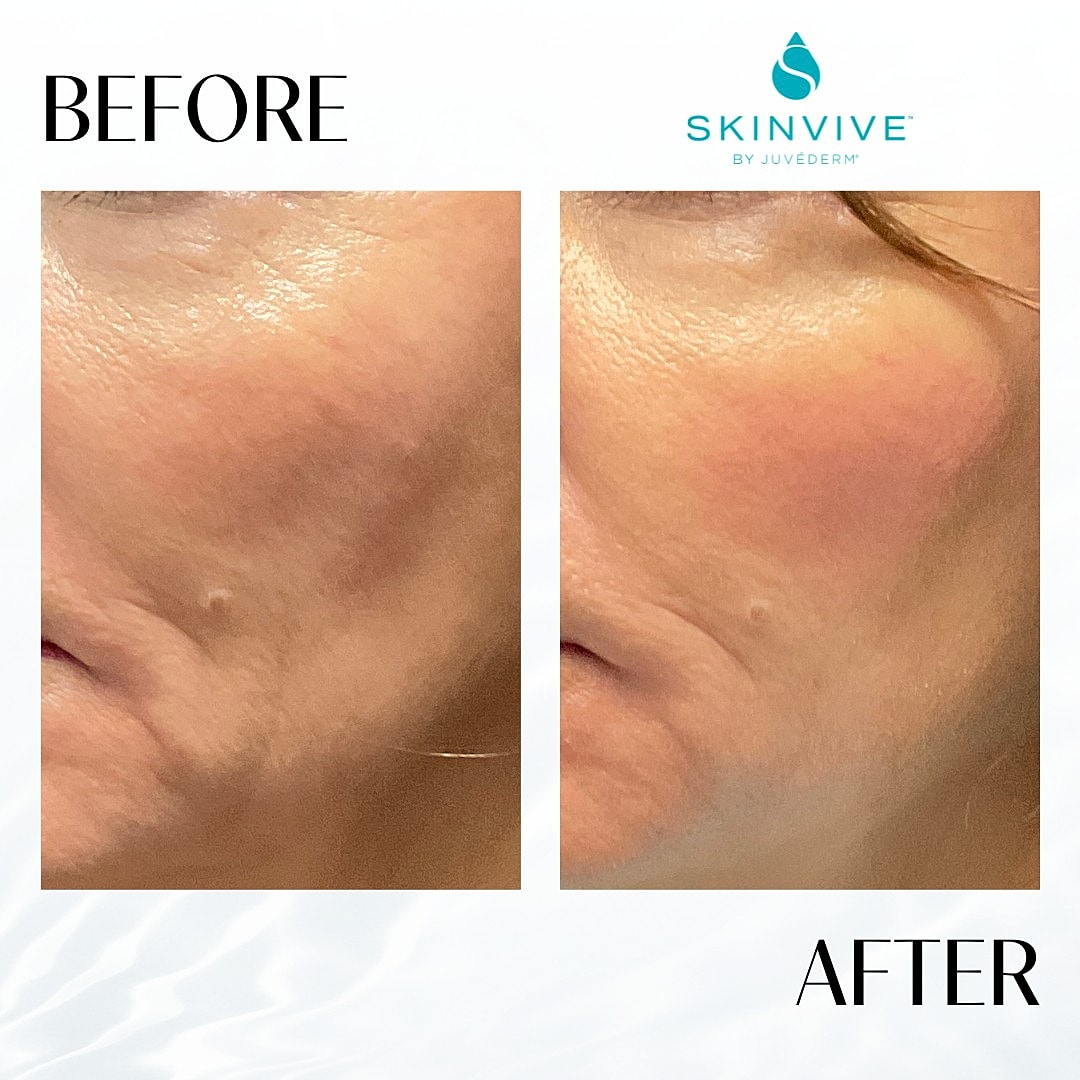 Skinvive Before & After