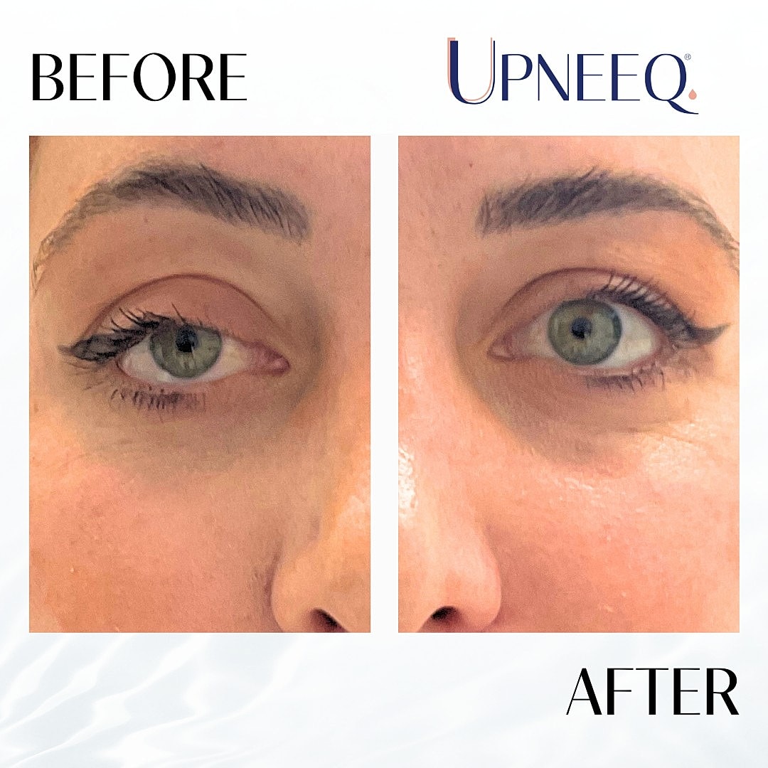 Upneeq Before & After