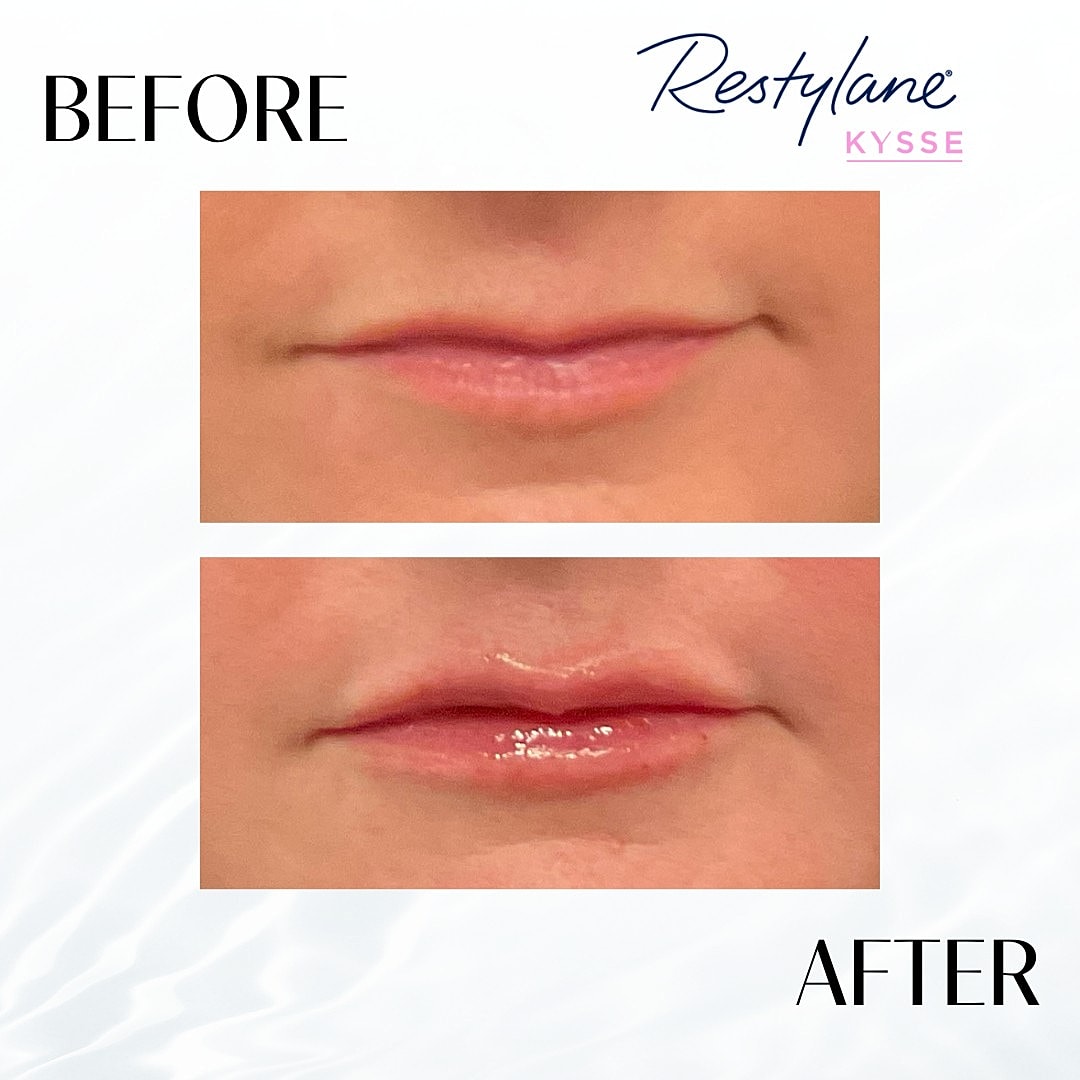 Lip Fillers Before & After