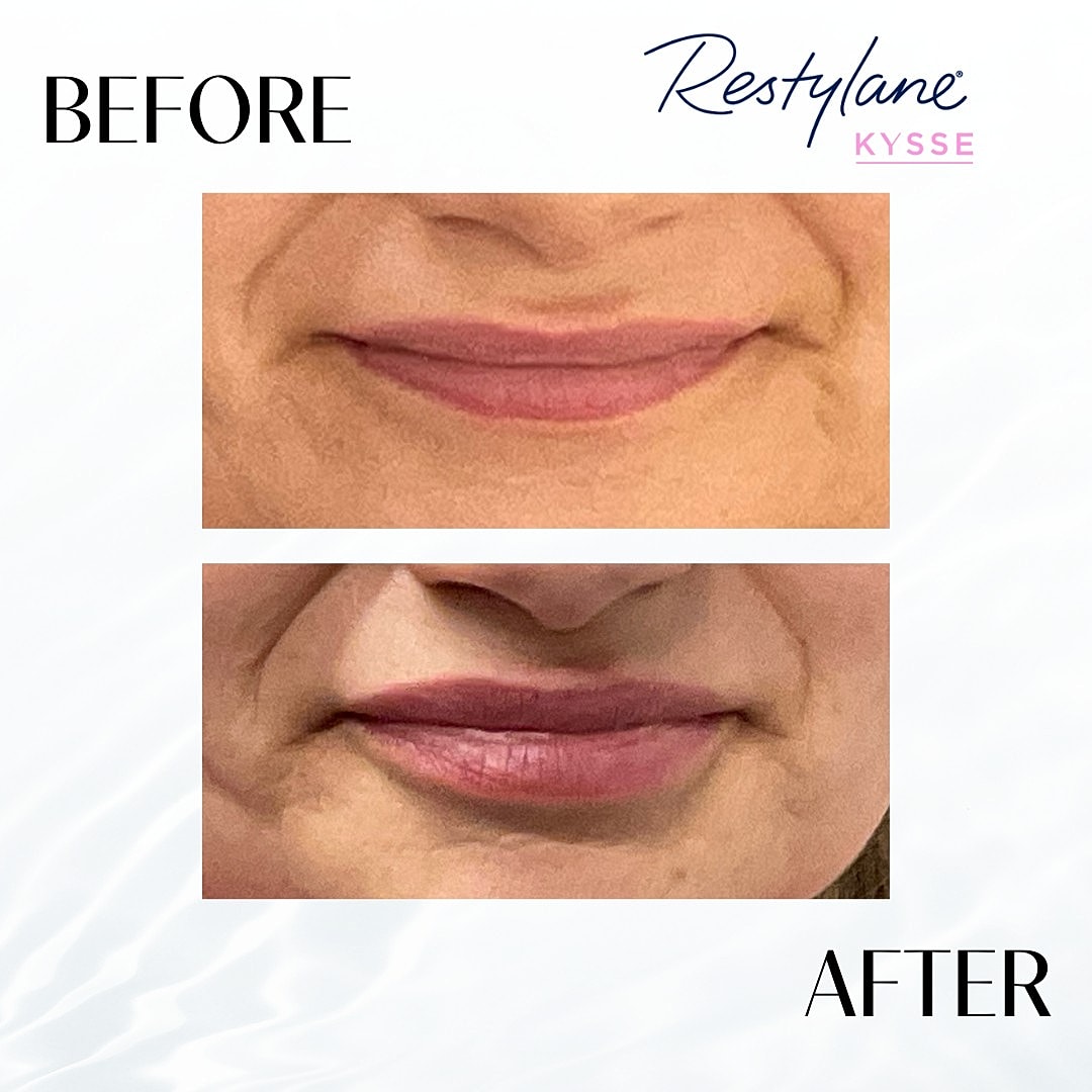 Lip Fillers Before & After