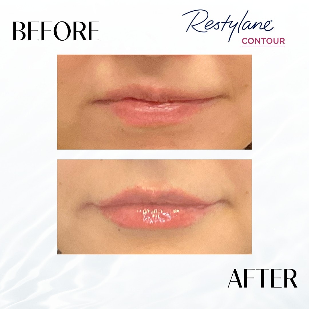 Lip Fillers Before & After