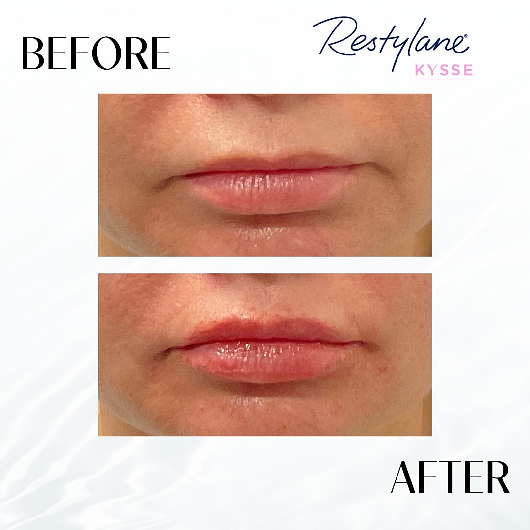 Lip Fillers Before & After