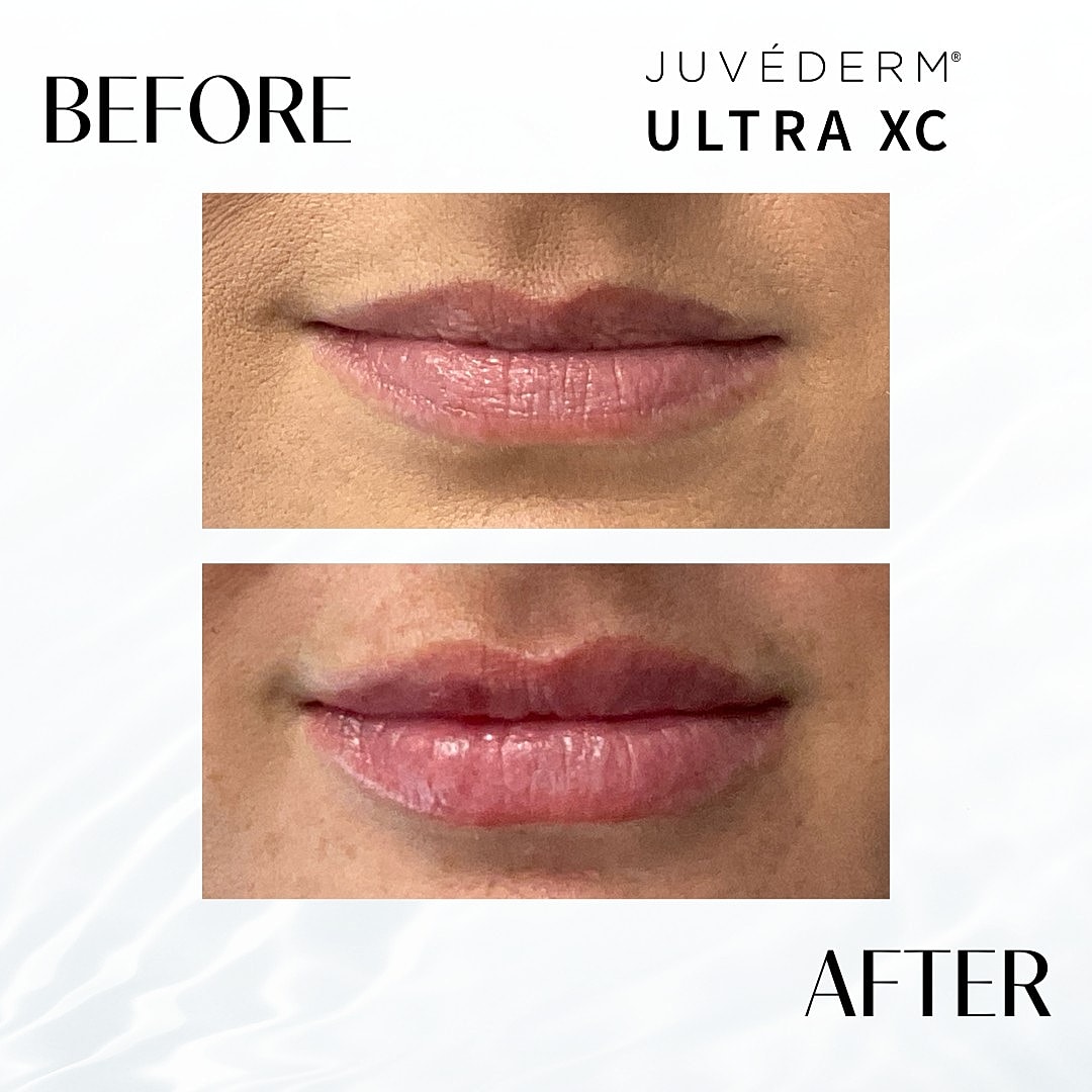 Lip Fillers Before & After