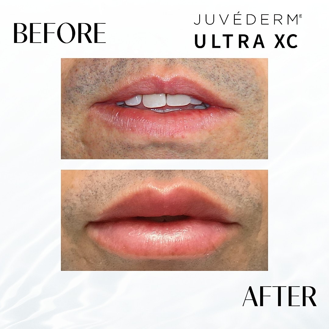 Lip Fillers Before & After