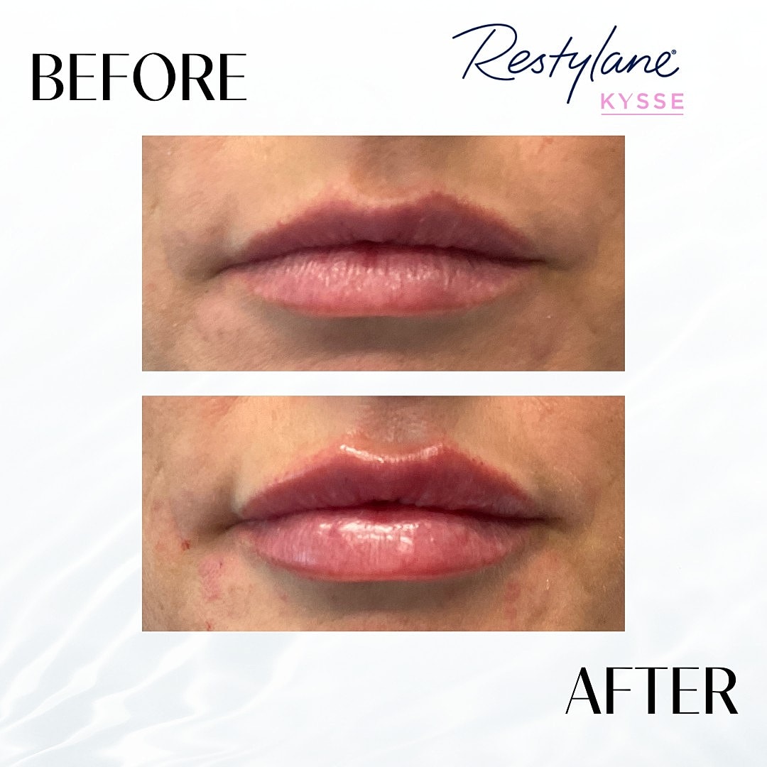 Lip Fillers Before & After