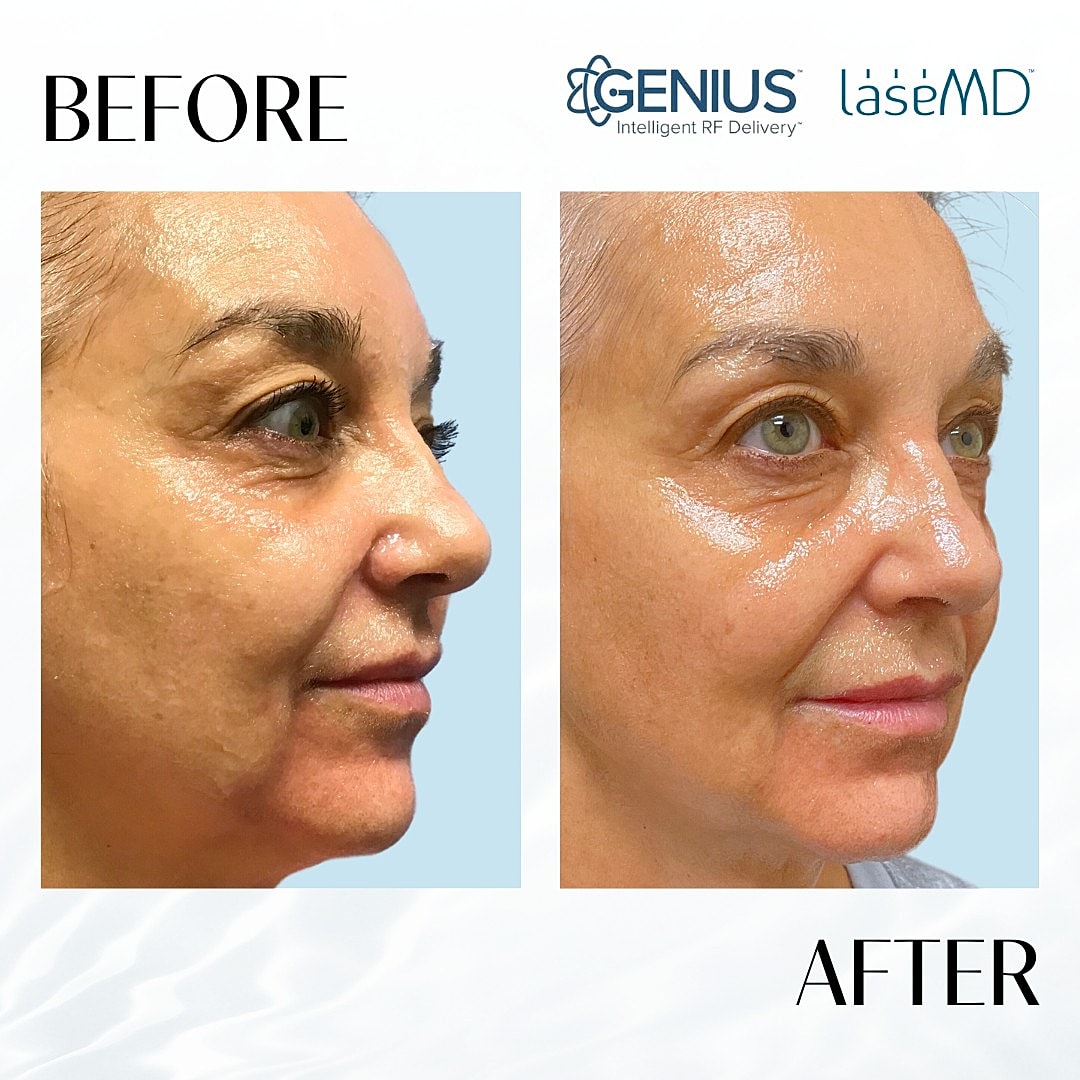 Genius Before & After