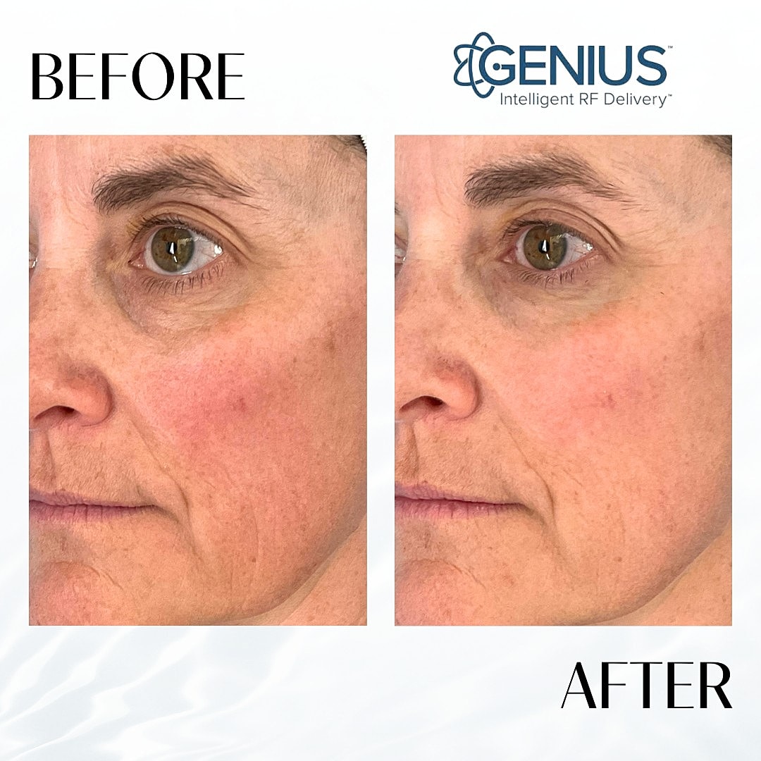 Genius Before & After