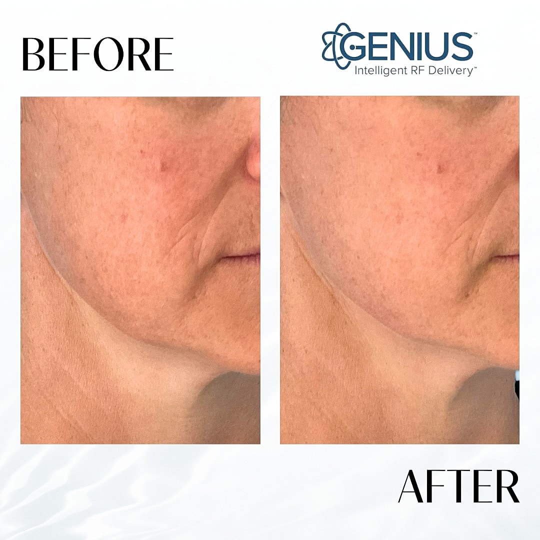 Genius Before & After