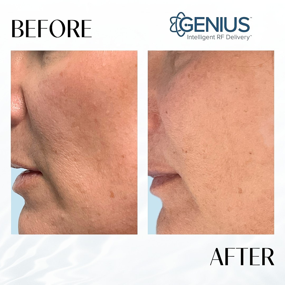 Genius Before & After