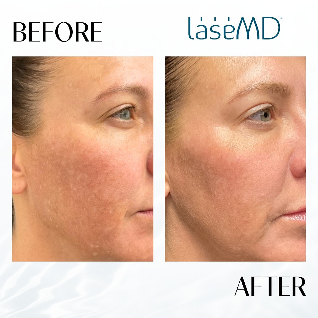 Lasemd Before & After