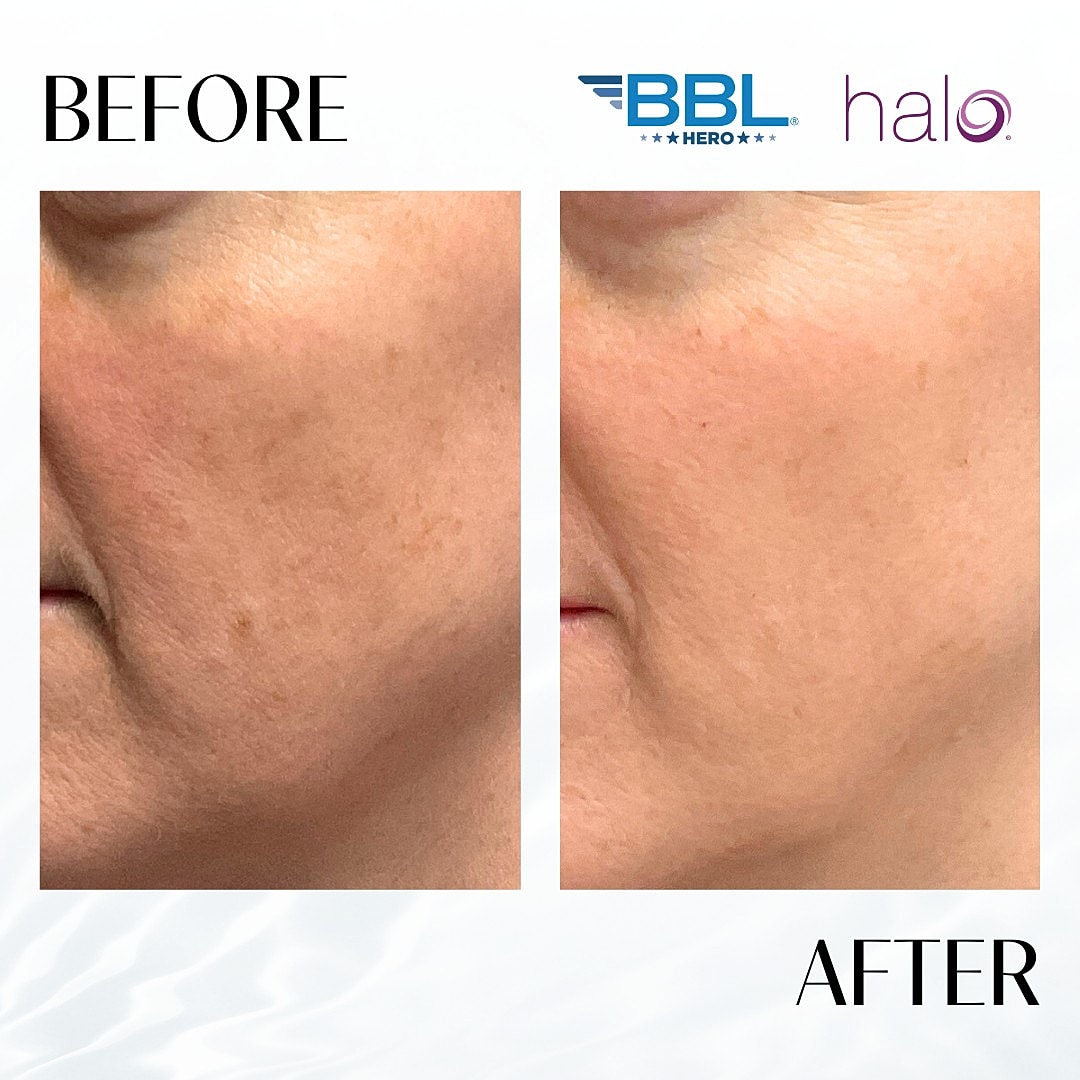 Halo Laser Before & After