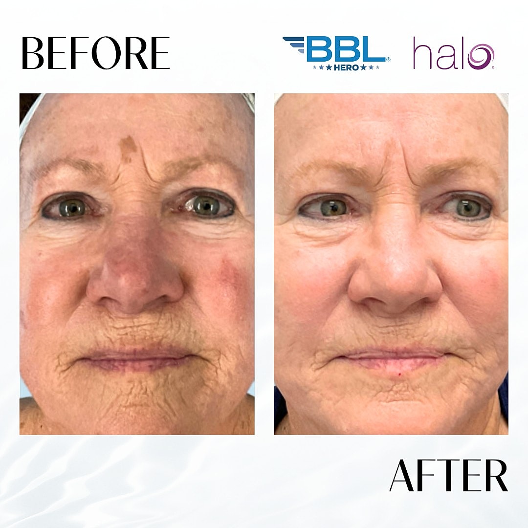 HALO Laser Before & After