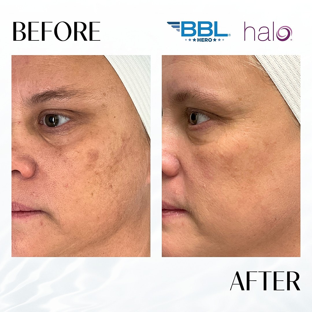 HALO Laser Before & After