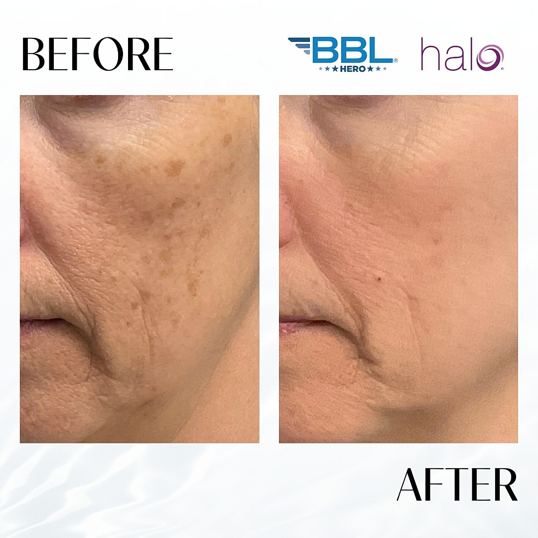 Halo Laser Before & After